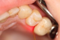 Parodontaltherapie - Zahnarztpraxis in Wildenfels
